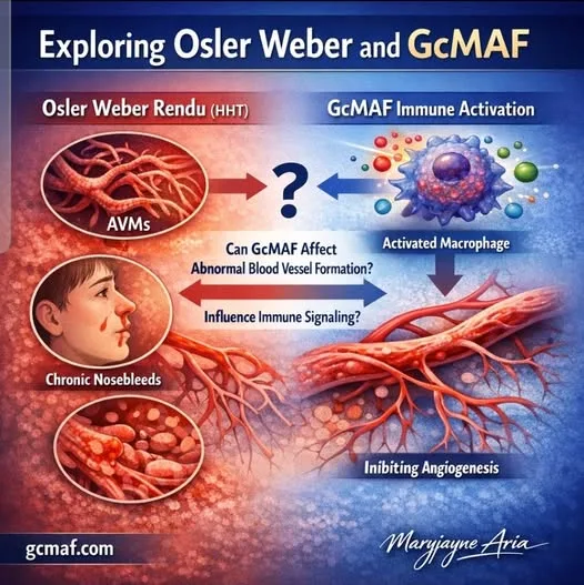 Gcmaf and its supportive role in  Osler Weber Rendu syndrome: